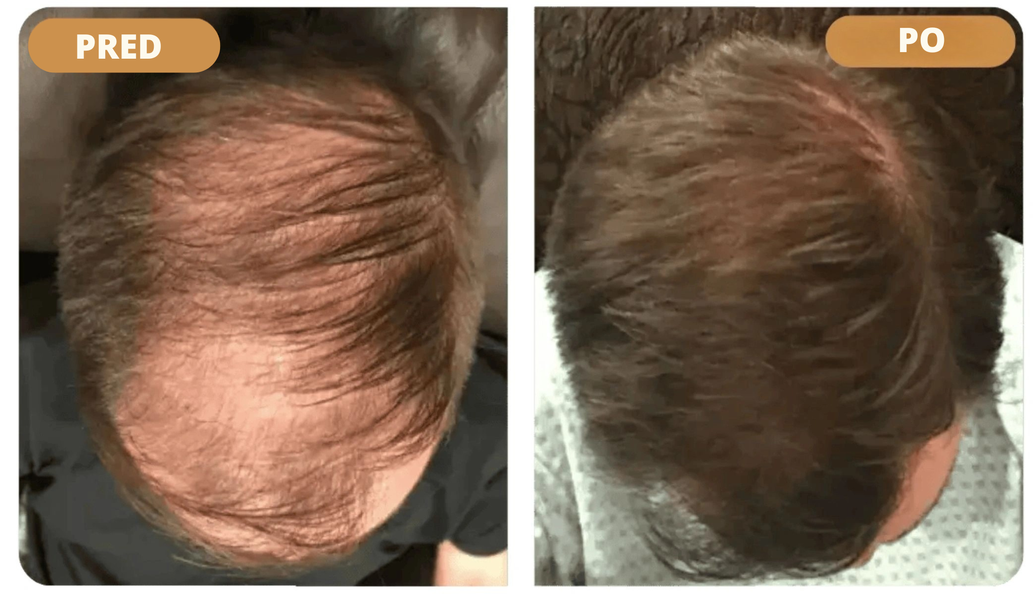 Orylo™ RootBoost Šampón na regeneráciu vlasov