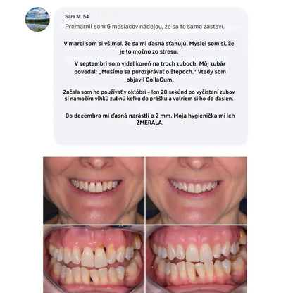 Collagen Powder for Gums